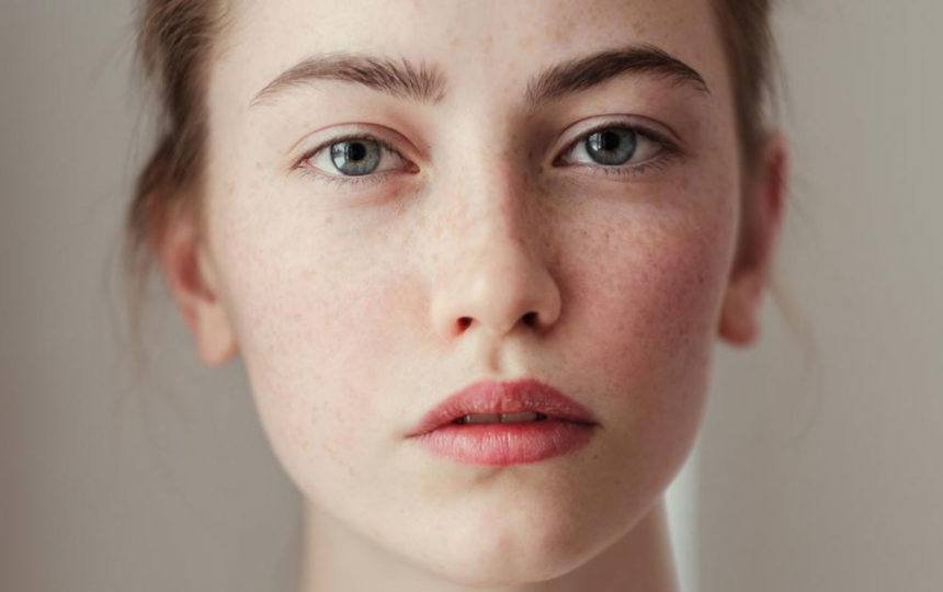 Simple home remedies for freckles