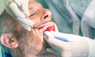 Simple yet effective ways to prevent and remove dental plaque