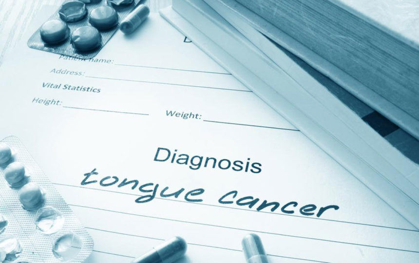 Symptoms of tongue cancer you should not ignore