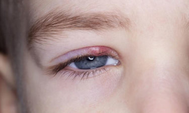 The 4 common causes of blepharitis