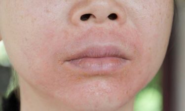 Treatment Methods for Lupus Skin Rashes