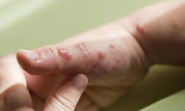 Treatment for symptoms of viral infections
