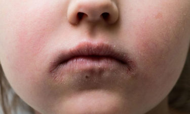 Understanding the causes of impetigo in children and adults