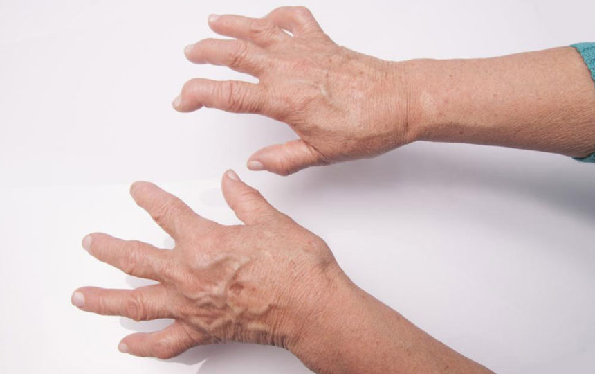 What you need to know about Rheumatoid Arthritis and Lupus