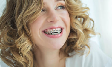 A guide to adult braces