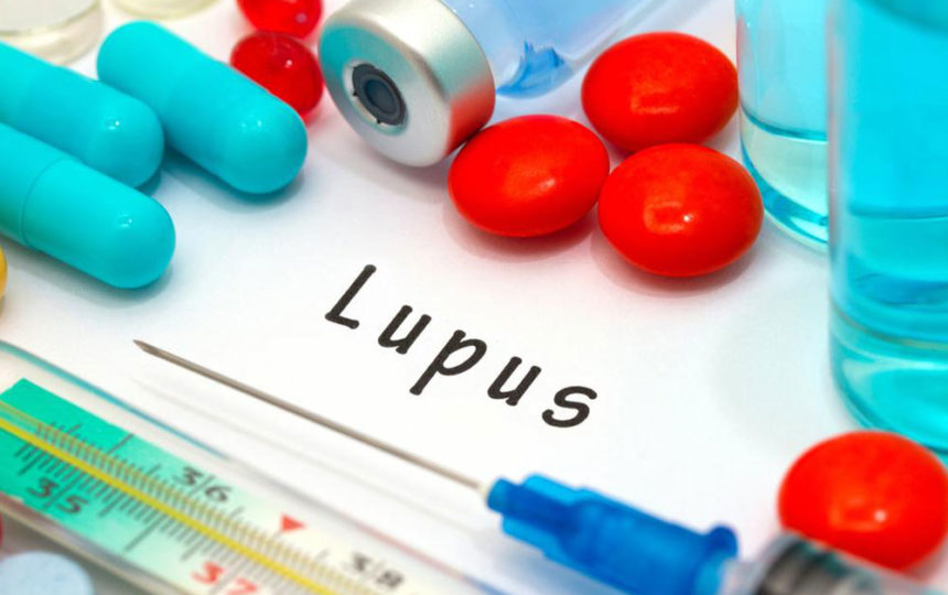 Remedies for Lupus