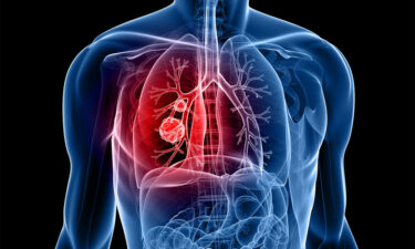 5 cities with the highest rates of lung cancer