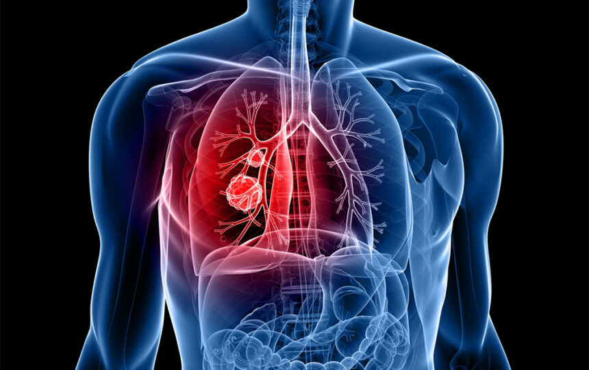 5 cities with the highest rates of lung cancer