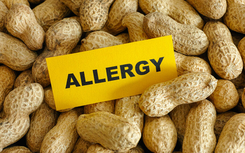 5 most common food allergies