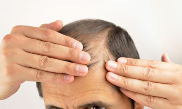 Hair loss – Its symptoms and causes